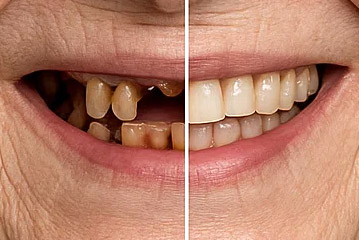 Full Mouth Reconstruction EV Dental PC Englewood, NJ